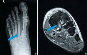 Lisfranc joint complex injury can occur as a result of direct or indirect trauma.3, 11 direct trauma occurs when an external force strikes the foot. Undisplaced Subtle Ligamentous Lisfranc Injuries Conservative Or Surgical Treatment With Percutaneous Position Screws Sciencedirect
