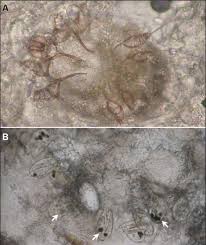 Image result for scabies norvegica