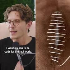 Brion Bishop Addiction Update: Huberman Podcast Highlights