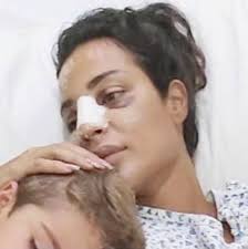 نادين نجيم نشرت سابقا اثار الاصابة في وجهها. Ø¨Ø¹Ø¯ 150 Ù‚Ø·Ø¨Ø© Ø¨ÙˆØ¬Ù‡Ù‡Ø§ ÙˆØ¬Ø³Ø¯Ù‡Ø§ Ù†Ø¬ÙŠÙ… Ù„Ù…ØªÙ‡ÙƒÙ… Ø§Ù„Ø¯Ù†ÙŠØ§ Ø¯ÙˆØ§Ø±Ø© Ø£Ø®Ø¨Ø§Ø± Ø§Ù„Ø³Ø¹ÙˆØ¯ÙŠØ© ØµØ­ÙŠÙØ© Ø¹ÙƒØ§Ø¸