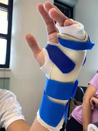 Image result for Ulnar Gutter Splint