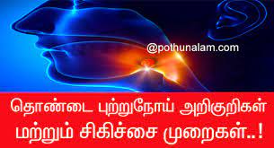 Common early symptoms of throat cancer might include: à®¤ à®£ à®Ÿ à®ª à®± à®± à®¨ à®¯ à®…à®± à®• à®± à®•à®³ à®…à®¤à®© à®š à®• à®š à®š à®® à®± à®•à®³