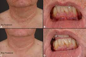 Whilst there isn't a cure, removing the plaques and getting any possible health issues in check, will mean an end to your xanthoma.we will explain several xanthelasma palpebrarum treatment options available, with the goal of helping you get all the awareness you require, no matter what your concerns on this skin condition is. Cutaneous And Laryngopharyngeal Papules Of Xanthoma Disseminatum Successfully Treated With 2 Chlorodeoxyadenosine Jaad Case Reports