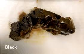Image result for dark black stool human poop