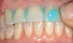 How to restore tooth enamel naturally, and remineralize your teeth. Rubbing Toothpaste On Your Teeth Quadruples Protection Against Decay Daily Mail Online
