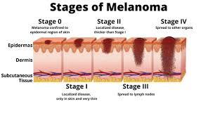 Melanoma is one of the most serious forms of skin cancer. Stages Of Melanoma Aim At Melanoma Foundation