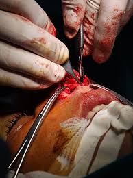 Image result for ‫فیلم جراحی بینی‬‎