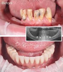 Designed to deep clean gums. All On 6 Full Set Of Fixed Teeth On 6 Dental Implants Dental Implant Surgery Tooth Extraction Aftercare Dental Implants Cost