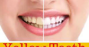 Yellow Teeth Remedy On How To Get Rid Of Them Yellow Teeth Yellow Teeth Remedy Teeth Remedies