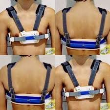 ortese compressor dinamicas pectus carinatum heart surgery rehabilitation gmail