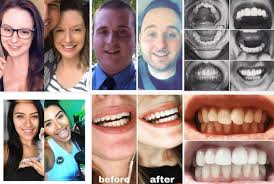 Before smile direct club came into the picture, the only way for people to get straighter teeth is to visit a dentist's office, which was not it was absolutely worth it and glad i finally have smile to be proud of. kevvy0523 writes: Smiledirectclub Reviews Is It Safe Legit Everything You Need To Know Before After Advisoryhq