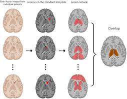 Image result for Neurologic Lesion Localization