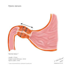 This article provides a beginners guide to ultrasound, including how ultrasound works and how the article also covers ultrasound guided venous access and fast scanning in the context of trauma. Pyloric Stenosis Radiology Reference Article Radiopaedia Org
