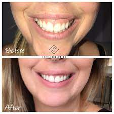 We did not find results for: Gummy Smile Facial Sculpting
