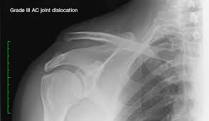 Image result for AC Dislocation