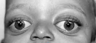 Antimongoloid Slanting Palpebral Fissures Rare Care World