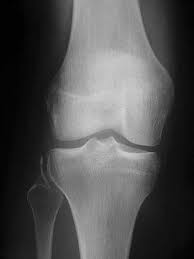 Anterior cruciate ligament (acl) injury. Is The Segond S Fracture A Reliable Sign Of Anterior Cruciate Ligament Acl Tear A Case Report Without Associated Acl Rupture Springerlink