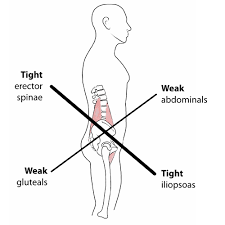 Lower X Syndrome Lower Crossed Syndrome