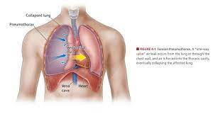 Pneumothorax is the buildup of air or gas in the pleural space (the space between the lung and chest wall), which causes the lung to collapse. Tension Pneumothorax A One Way Valve Air Leak Occurs From The Lung Download Scientific Diagram