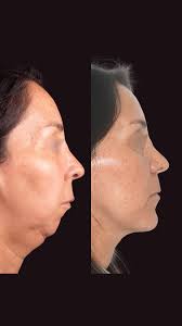 Cirugía Ortognática en paciente Clase III con Asimetría 👉🏼Les comparto un  nuevo caso de antes y después de nuestra querida paciente la cual  presentaba una Clase III Esqueletal por un prognatismo mandibular