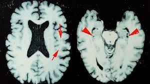 NFL: At least one in four dead players had brain disease, says study