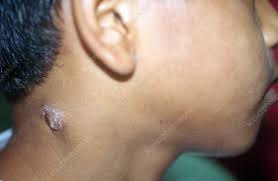 Morphologically it is characterized by a subcutaneous node forming an abscess with secondary perforation of overlying skin. Tuberculosis Colliquativa Cutis Keyword Search Science Photo Library