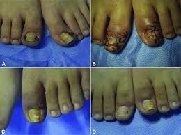 Image result for Paronychia feet