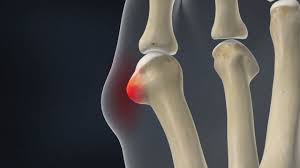 Check spelling or type a new query. Tailor S Bunion Bunionette The Frankel Foot Ankle Center