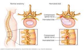 Damage or shortcoming can make the internal bit of the disc jut through the external ring. Herniated Disk Symptoms And Causes Mayo Clinic