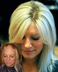Rachel Before And After Intralace Hair Loss Treatment Hair Treatment Hair Loss Women