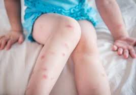Image result for bedbug bites look like