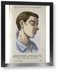 Image result for Tertiary Syphilis