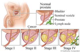 The first exam is a blood test to determine if there are abnormal prostate specific antigen (psa) levels in your bl. Prostate Cancer Screening Dr Rb Friedman Dr Rb Friedman Prostate Cancer Screening