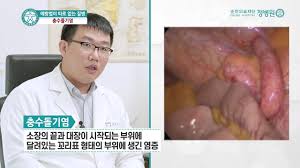 • 불임환자를 위한 진단적 내시경시술. ì¶©ìˆ˜ëŒê¸°ì—¼ ì„±ë‚¨ì •ë³'ì› ì™¸ê³¼ Youtube