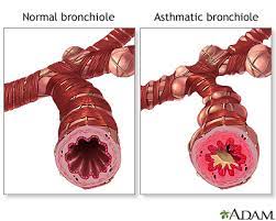 The list below does not include all potential medical conditions that could make you more likely to get severely ill. Asthma Medlineplus Medical Encyclopedia