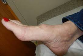 Cancer in your lymph nodes may point to lymphoma or another. Foot Bump On Top Of The Foot Consulting Footpain