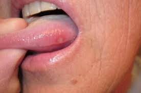 Home Remedies To Treat Blisters On Tongue Blister On Tongue Canker Sore Tongue Sores