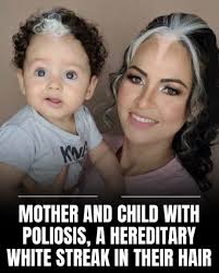 Some things are passed down through generations that go beyond just  memories. This mother passed down a rare white hair streak, a distinctive  mark from piebaldism, to her daughter. A beautiful link