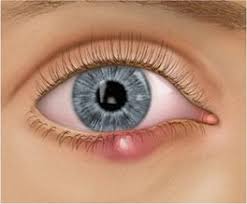 See full list on wikihow.com Eye Doctors Auckland Eye Doctors