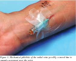 Image result for Peripheral IV Access