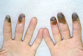 Check spelling or type a new query. Symptoms Of Vasculitis Johns Hopkins Vasculitis Center