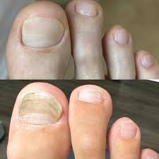 Image result for Onycholysis feet