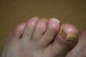 Image result for Onycholysis feet