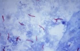 Ziehl Neelsen Stain Wikipedia