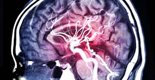 Do You Know The Basics About Brain Aneurysms Penn Medicine The larger the thoracic aortic aneurysm, or the faster it grows, the more likely it diagnosing a thoracic aneurysm is difficult because often there are no symptoms, and often the condition goes undiagnosed until a rupture occurs.