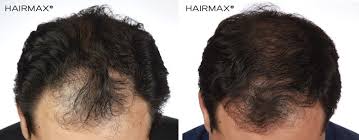 Androgenetic alopecia is the most common form of hair loss in men. Laser Hair Retention Therapy Hair Growth Men Transitions Hair