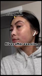Image result for Exercise-Induced Anaphylaxis