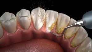 Cara Atasi Gigi Sensitif 30 Detik Sensitive Expert Pepsodent