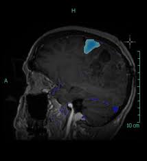 10 cc of prohance administered. Functional Mri Of The Brain Cedars Sinai
