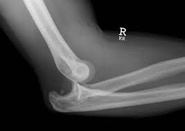 Some canine anatomical names may be familiar to you — dogs have elbows and ears and eyes — but other names may be downright foreign. The Elbow Joint Structure Movement Teachmeanatomy